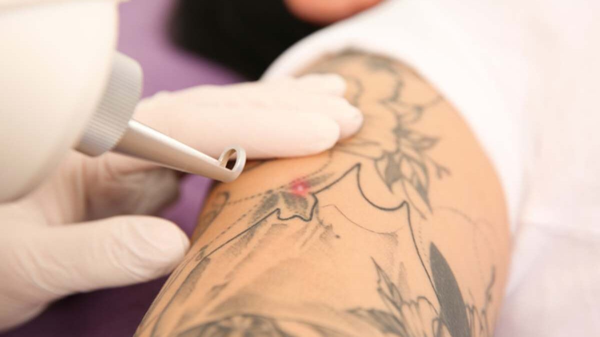 Top Technologies for Flawless Tattoo Erasing