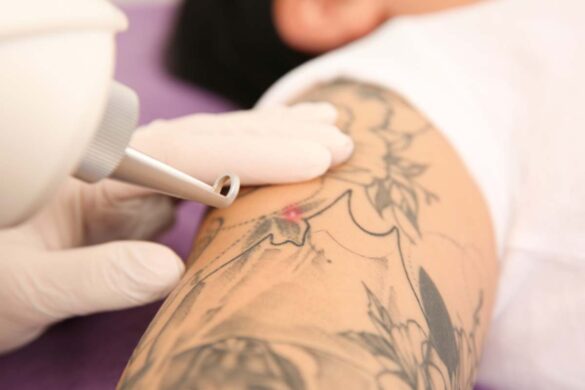 Top Technologies for Flawless Tattoo Erasing